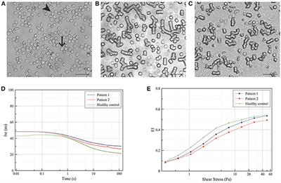 Disturbed Red Blood Cell Structure and Function: An Exploration of the Role of Red Blood Cells in Neurodegeneration